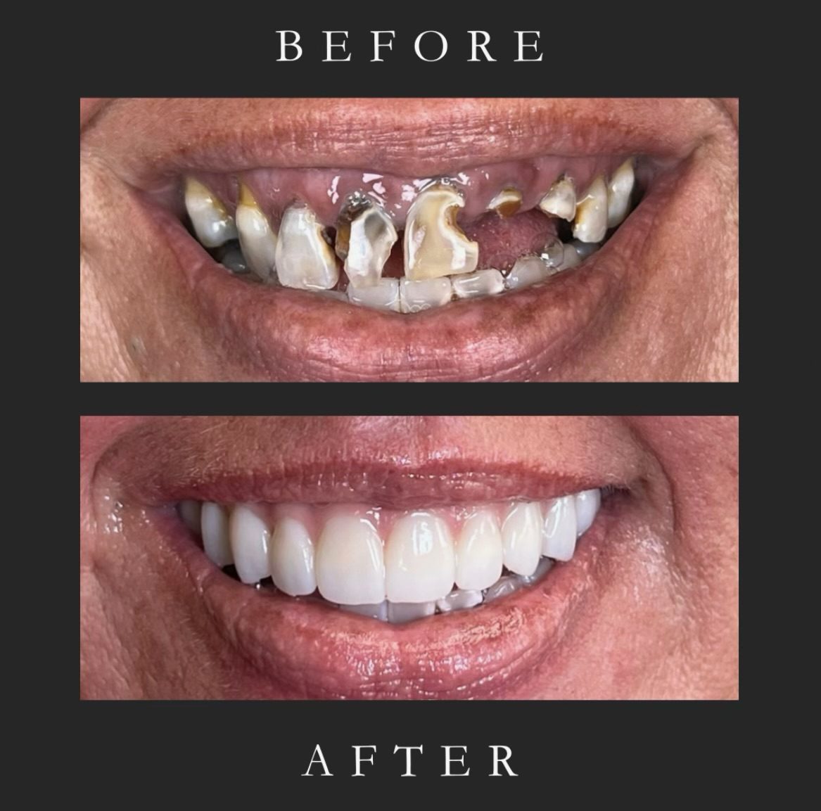 Before and after: a full smile restored