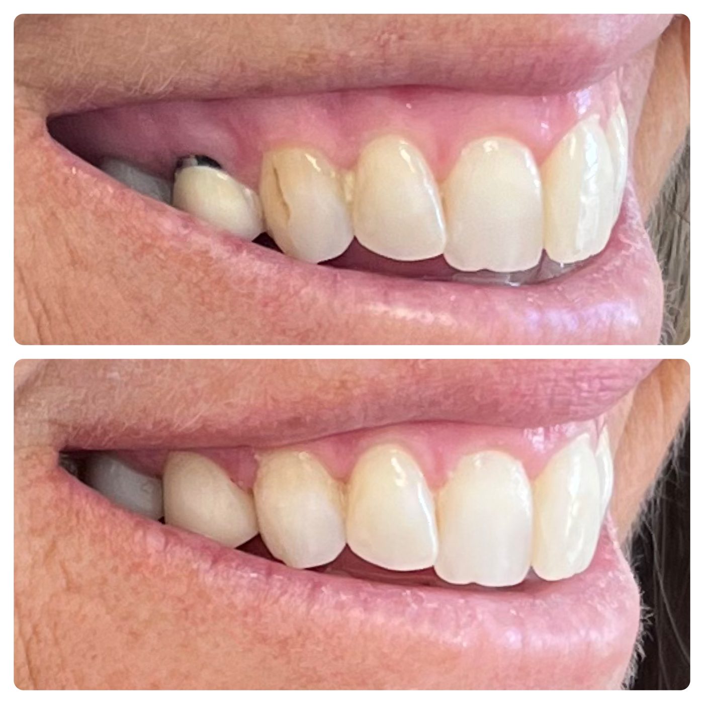 Before and after: a missing tooth replaced